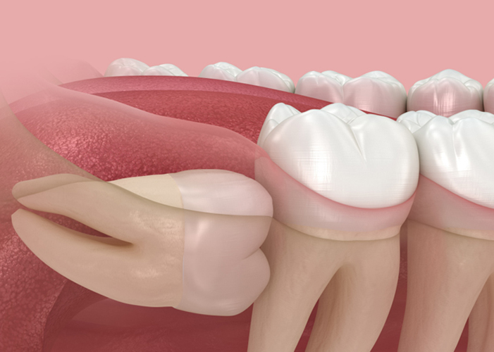 무삭제 라미네이트